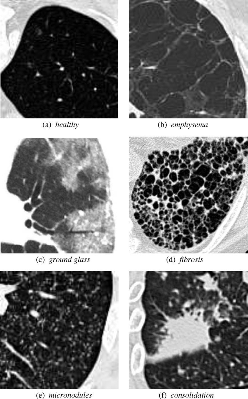 Examples of ILD's in CT Scan